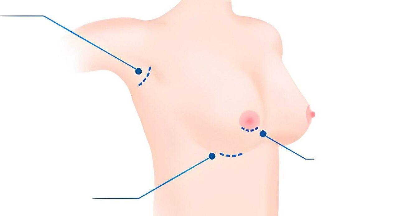 type sizes for breast augmentation